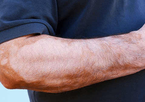 手臂白癜风发病有哪些症状？