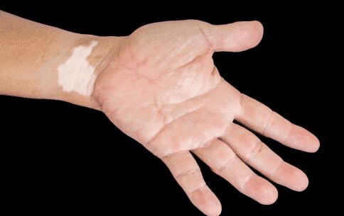 手部白癜风的治疗需要注意哪些方法?